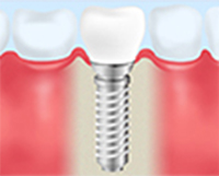 インプラント