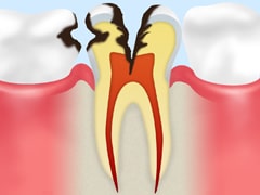 神経に達した虫歯