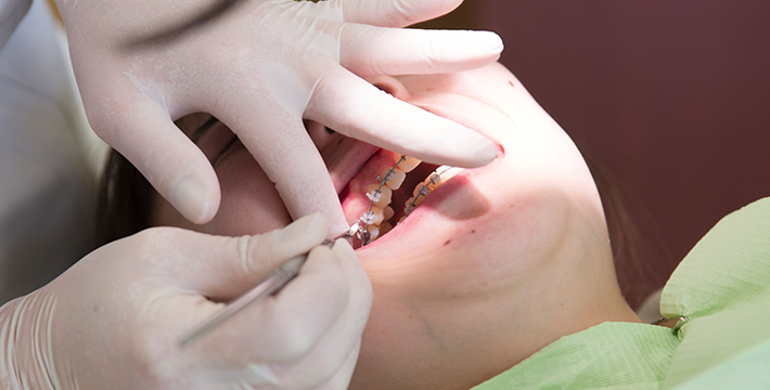 虫歯や歯周病の早期発見で発症を防げる